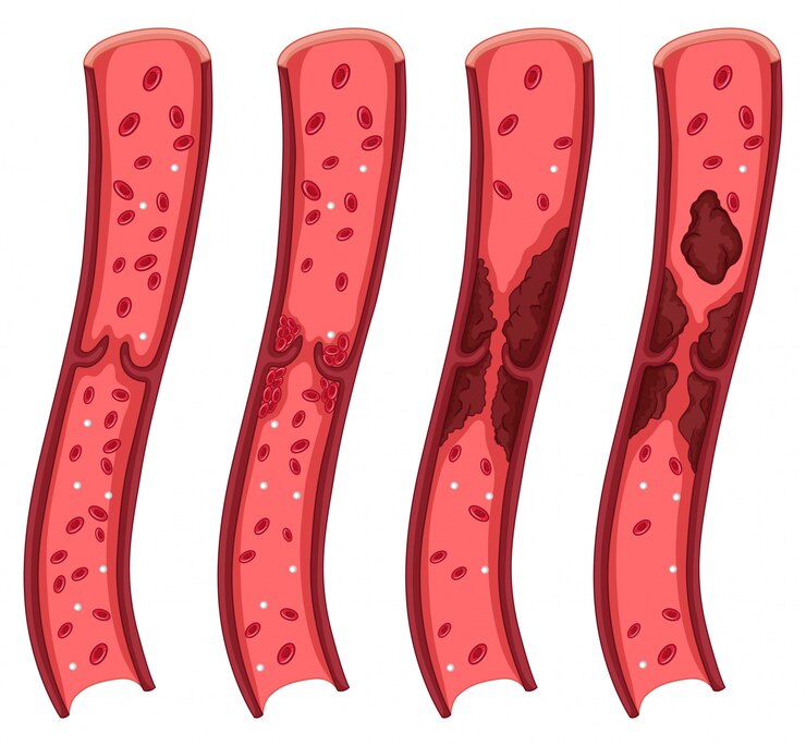 Ketahui Dini Penyakit Peripheral Artery Diases (Pad)